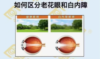 如何區(qū)分老花眼和白內(nèi)障？